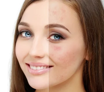 راهنمای جامع میکرودرم ابریژن
