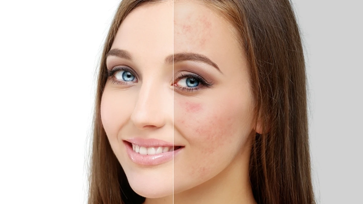 راهنمای جامع میکرودرم ابریژن