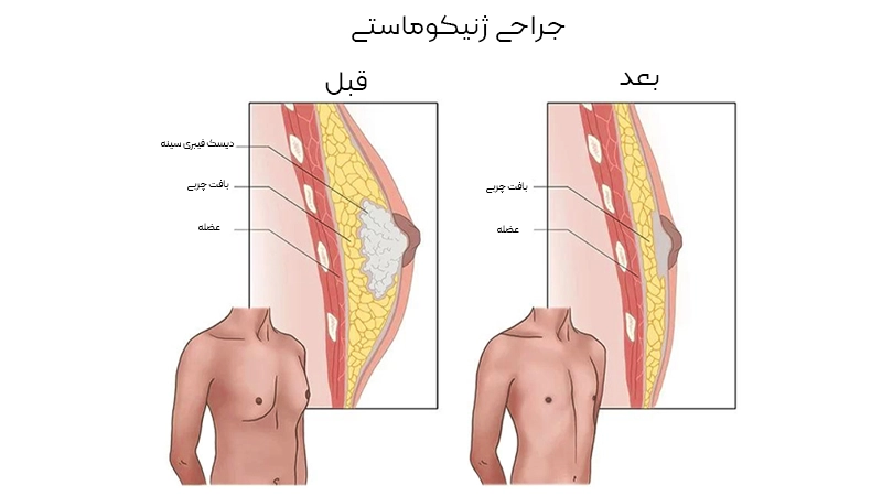 ژنیکوماستی (کاهش سینه مردان)