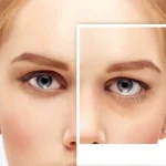تقارن-صورت-با-بلفاروپلاستی