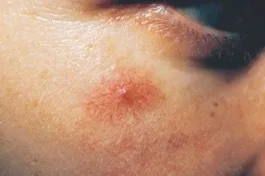 خال یا رگ عنکبوتى (spider angioma)
