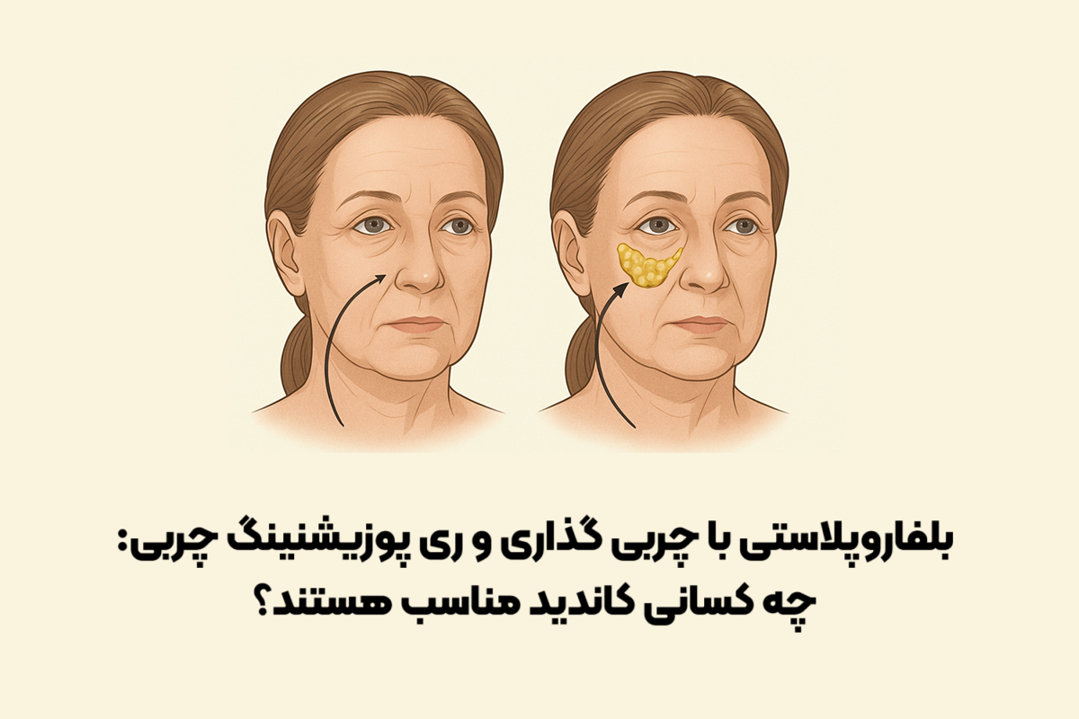 بلفاروپلاستی با چربی‌ گذاری و ری‌ پوزیشنینگ چربی: چه کسانی کاندید مناسب هستند؟