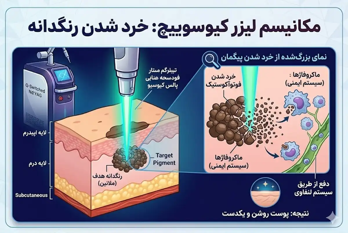 مزایا و معایب لیزر کیوسوییچ در مقایسه با مزوتراپی
