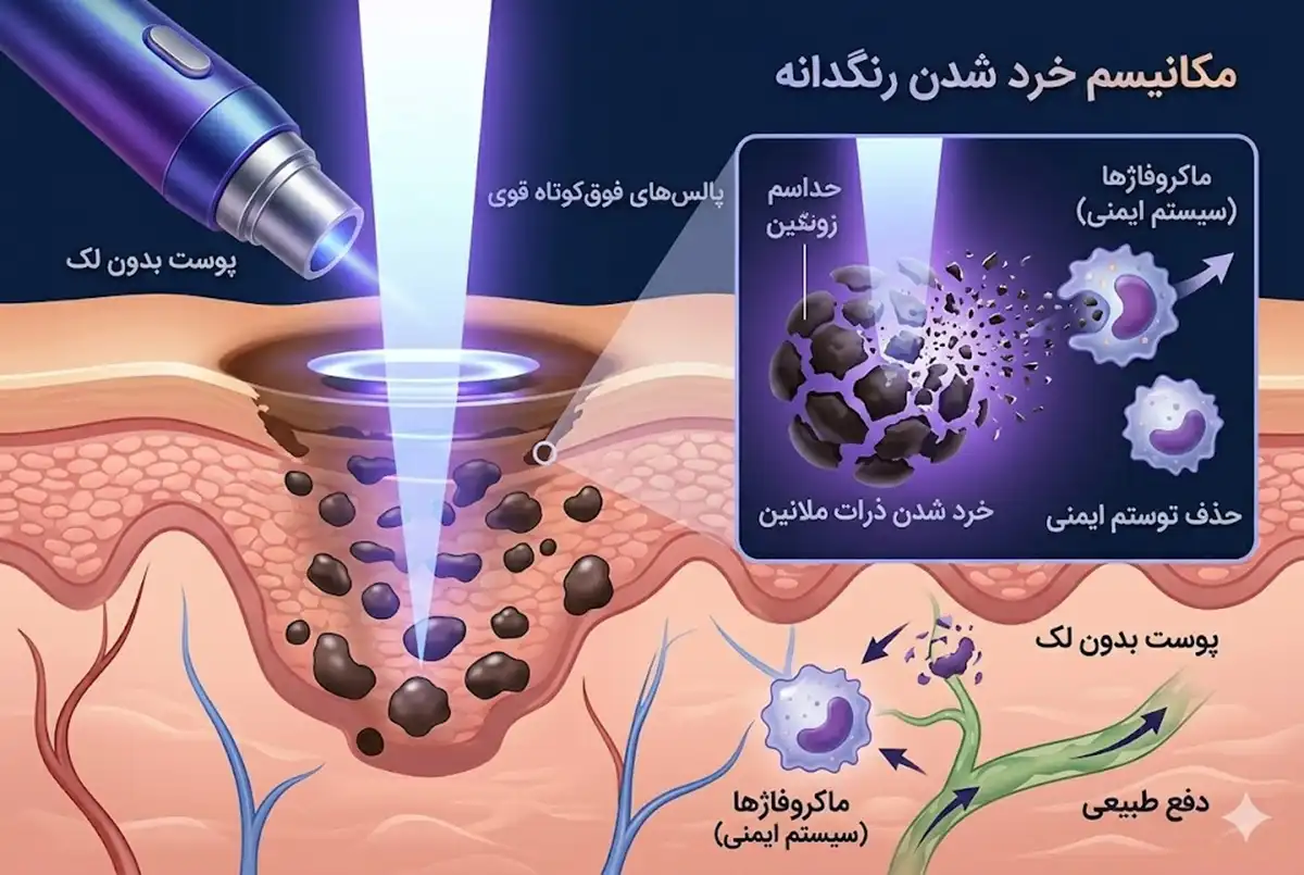 کیوسوییچ یا میکرونیدلینگ؛ کدام برای لک صورت مناسبتر است