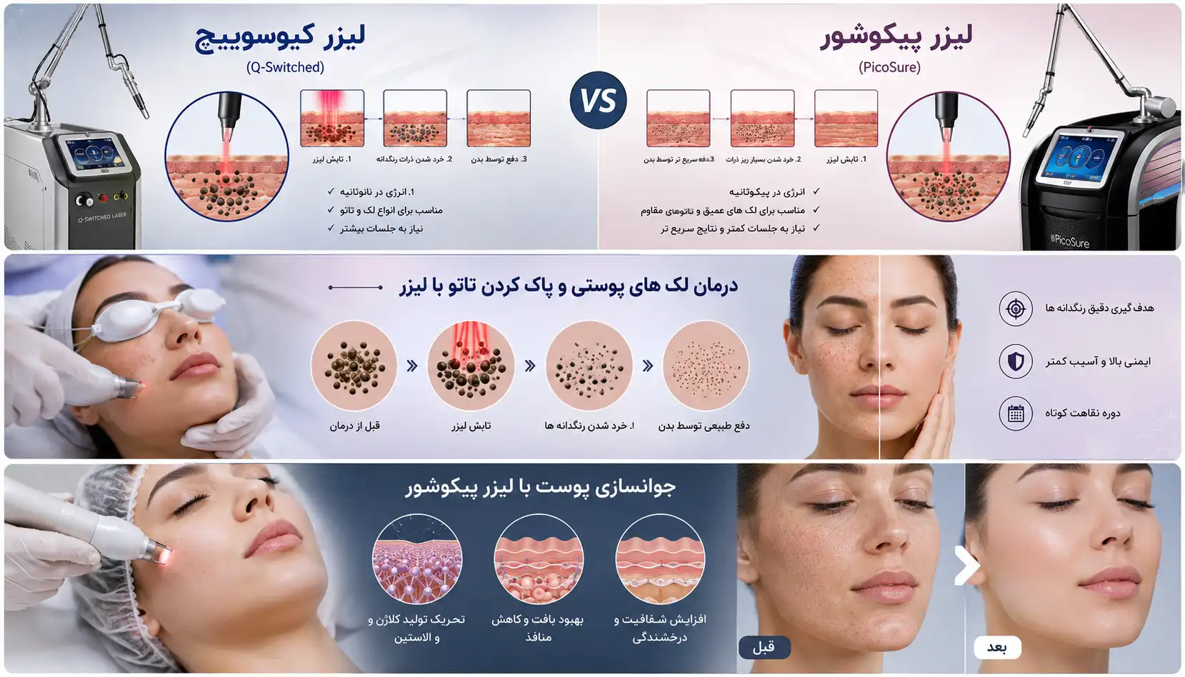 لیزر کیوسوییچ بهتر است یا پیکوشور؟