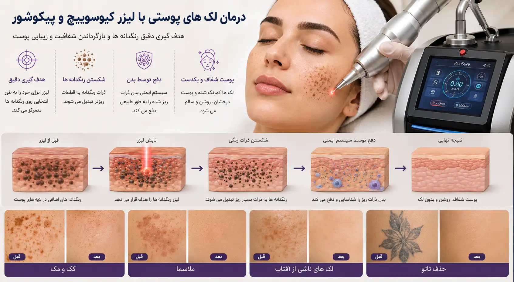 لیزر کیوسوییچ بهتر است یا پیکوشور؟