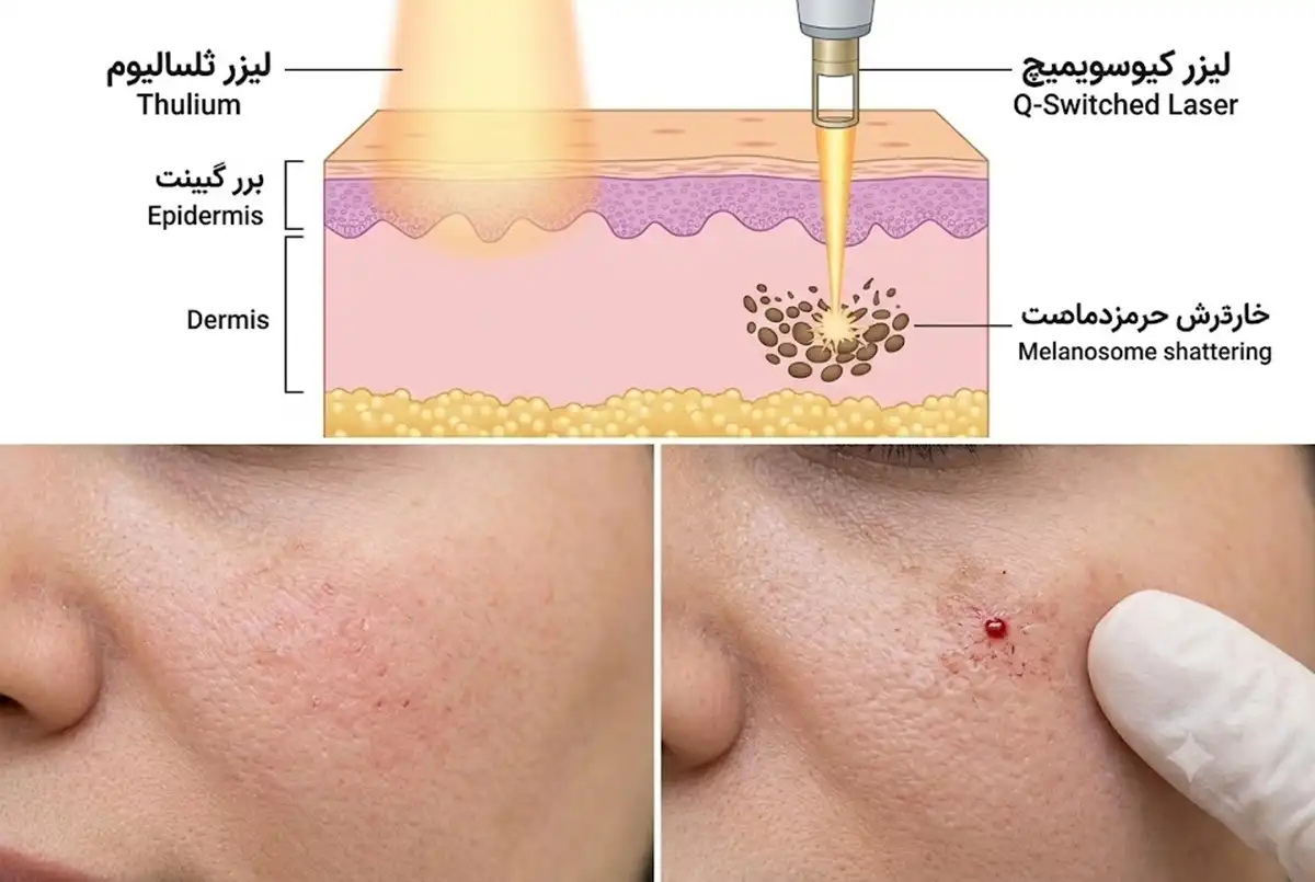 راهنمای انتخاب بین تالیوم و کیوسوییچ برای درمان لک های مقاوم