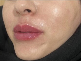 تزریق ژل لب | افزایش حجم لب‌ها و اصلاح فرم لب در کلینیک دکتربیتاساقی