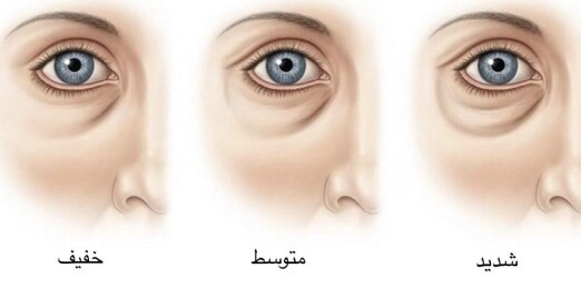 عوامل ژنتیکی و سبک زندگی تأثیر مستقیم در گودی زیر چشم دارند.