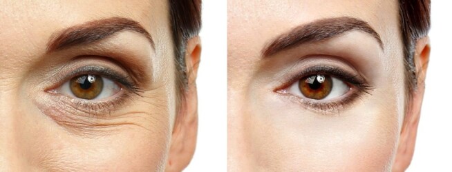 تزریق فیلر زیر چشم برای رفع گودی، سیاهی و چینوچروک