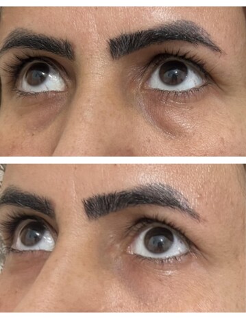 قبل و بعد از تزریق فیلر هیالورونیک اسید زیر چشم