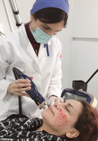 جوانسازی پوست با آر اف فرکشنال (Fractional RF)
