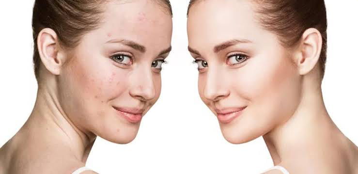 مراقبت‌های بعد از کربوکسی تراپی