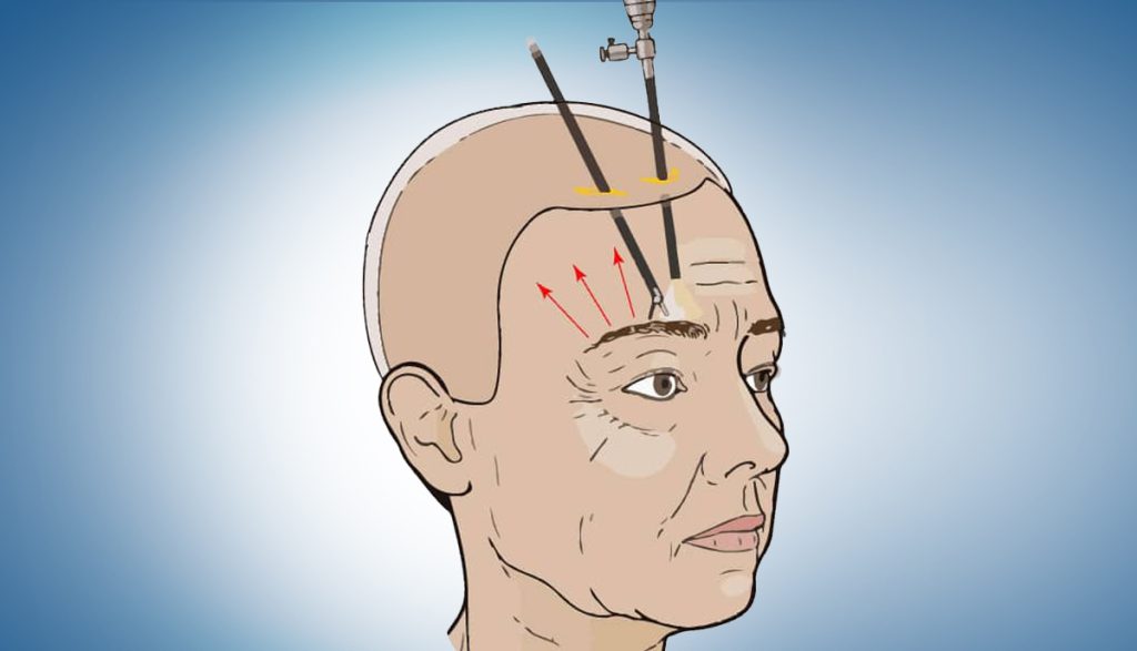 لیفت پیشانی و شقیقه به روش اندوسکوپیک