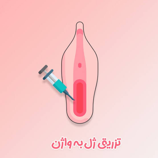 تزریق ژل به ناحیه تناسلی در تهران: هزینه، ماندگاری و نحوه انجام