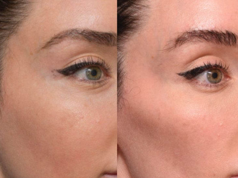فیلر گونه + تزریق فیلر گونه طبیعی در تهران به همراه مزایا و عوارض