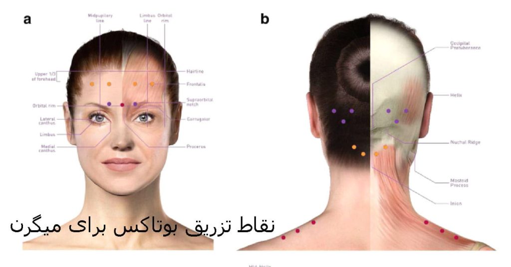 مراقبت‌های بعد از بوتاكس ميگرن