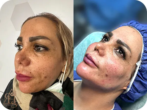 مراقبت‌های بعد از تزریق چربی