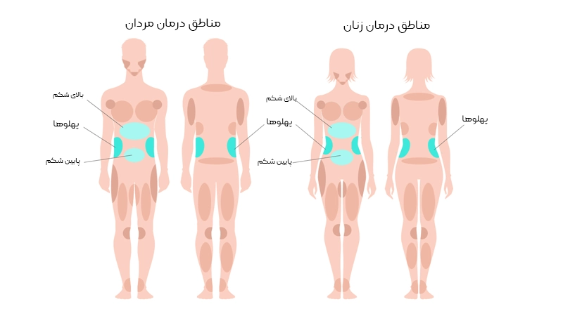 لیپوساکشن شکم، پهلوها و پشت